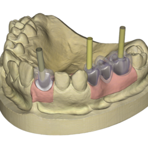 Örök licence - Implantátum Modul