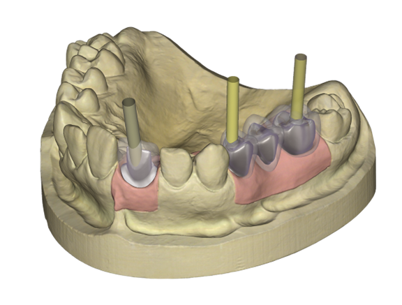 Örök licence - Implantátum  Modul