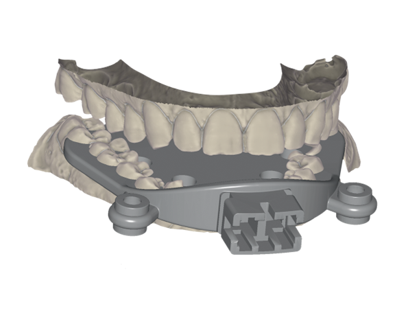 Örök licence - Állkapocs mozgás import Modul