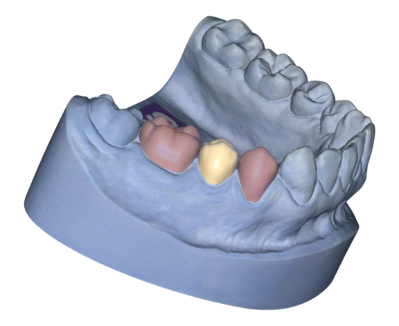 Örök licence - Ideiglenes Modul