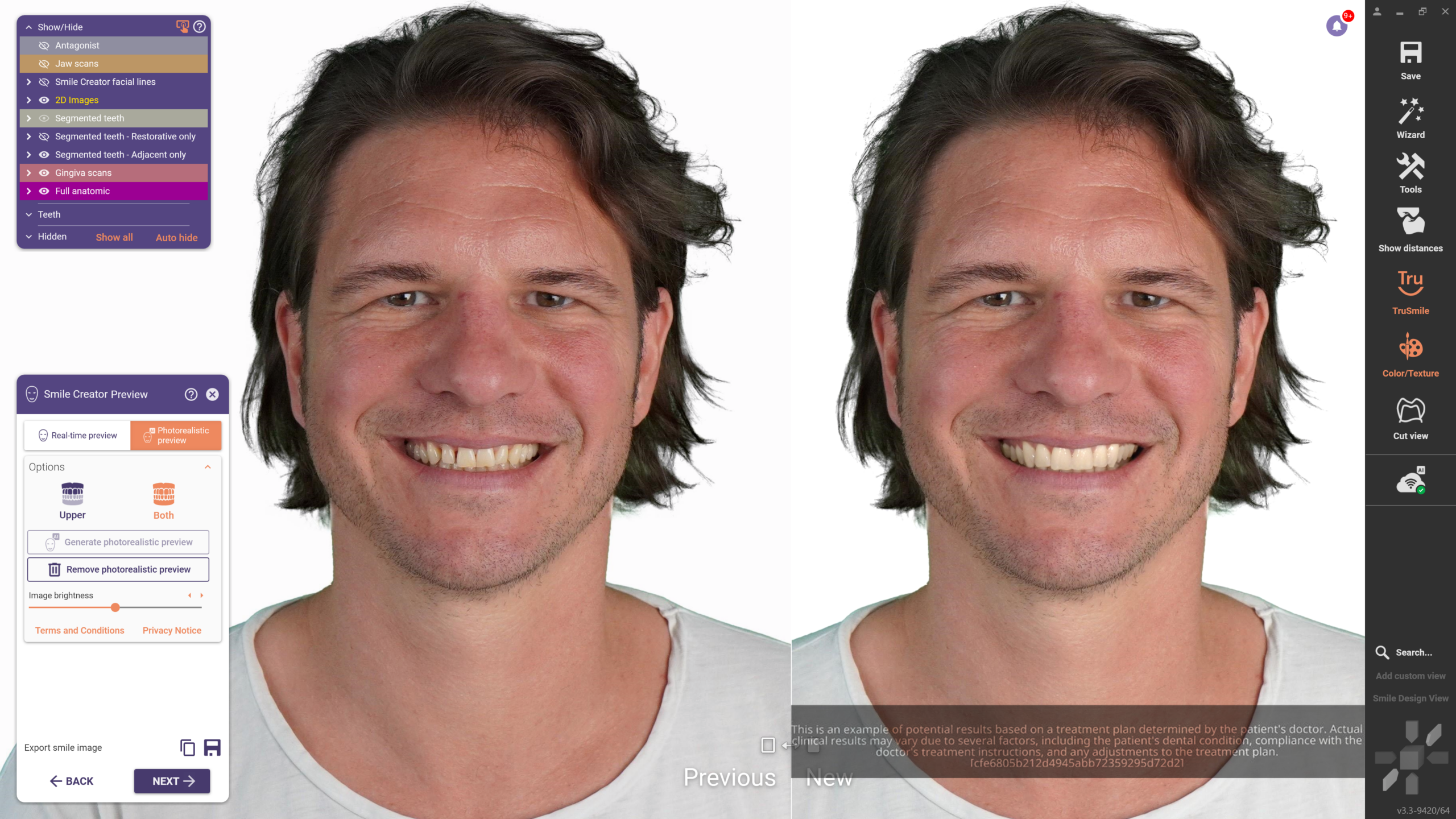 Örök licenc - TruSmile ™ modul