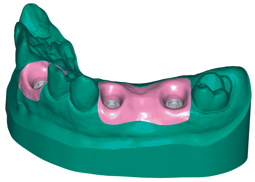 Modellkészítő implantátum-analógokkal