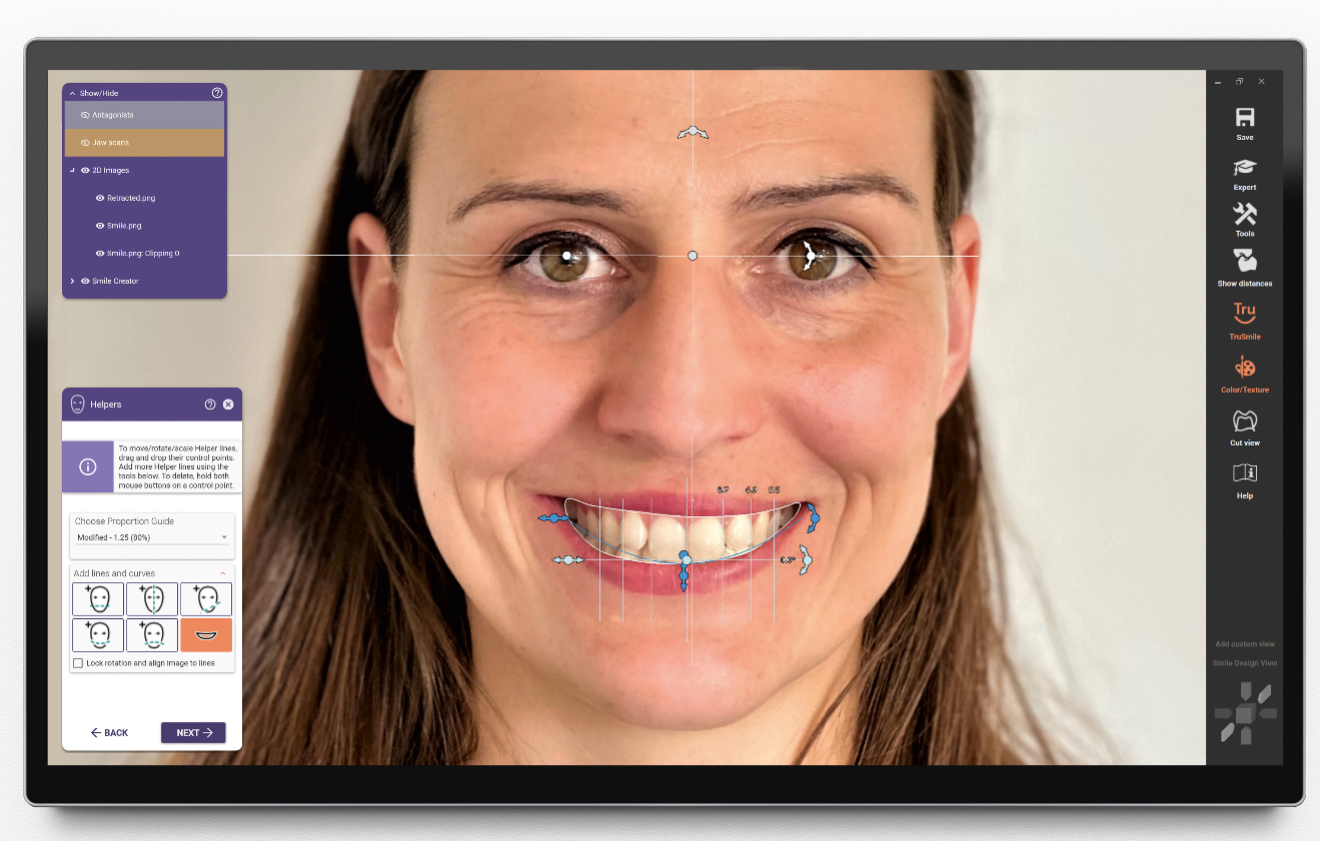 Mosolytervező TruSmile® modullal